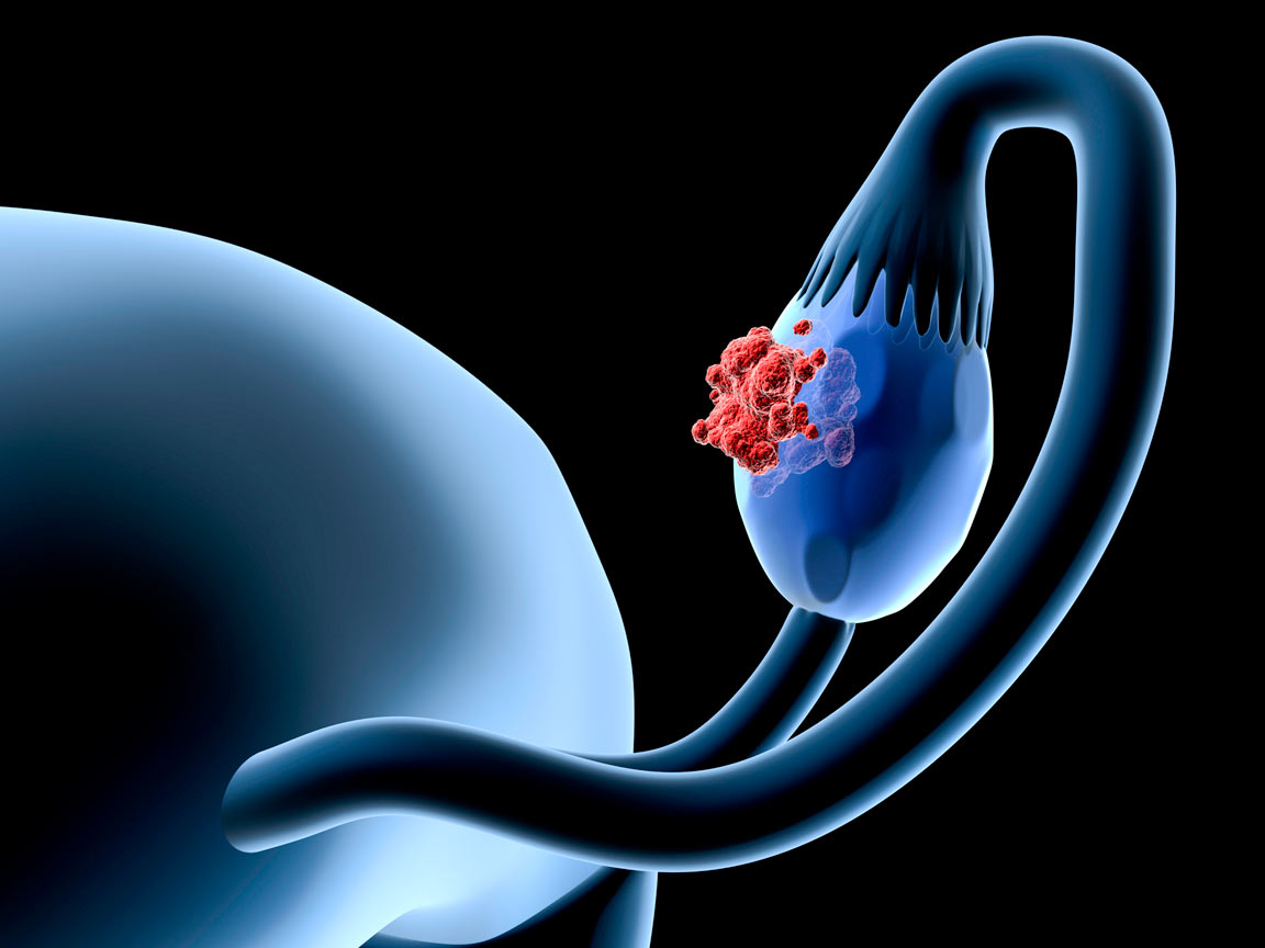 Research suggests quercetin may help women with metastatic ovarian cancer.