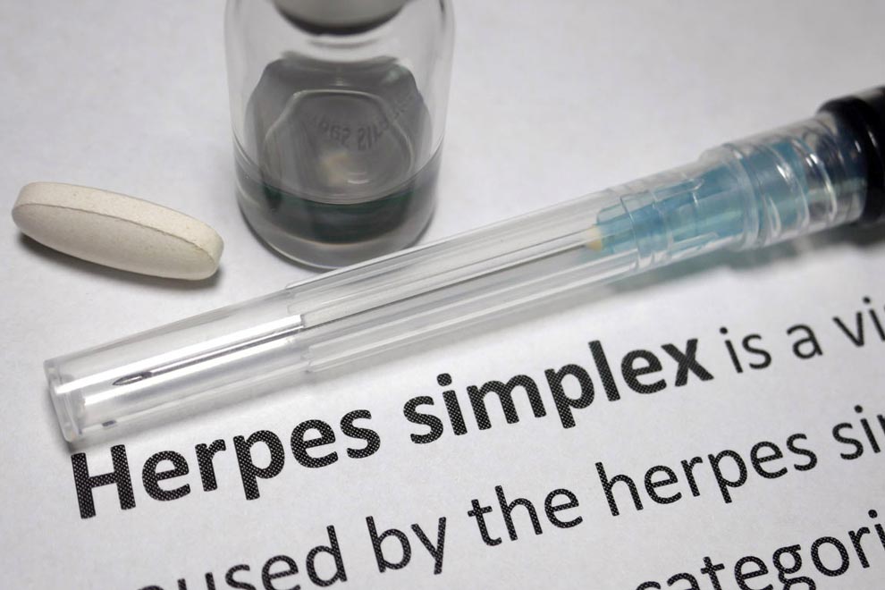 Quercetin may help treat genital herpes.
